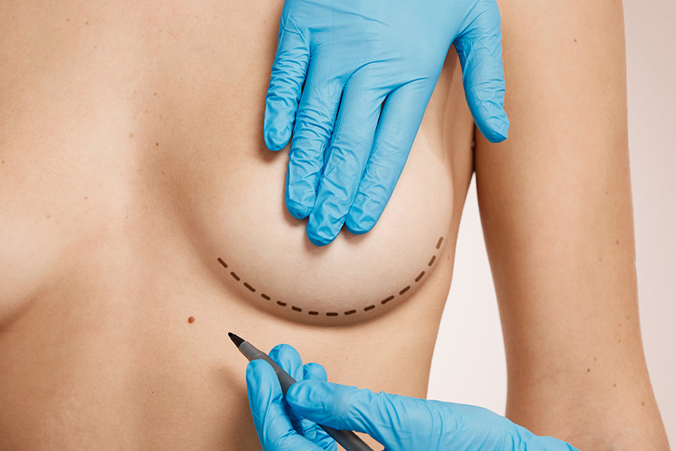 Breast Implant Removal & NAC surgery